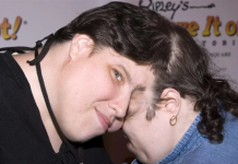 Починаа најстарите сијамски близнаци на светот