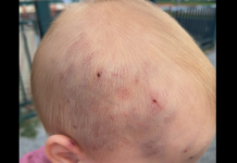 Мајка го пронашла своето бебе со модринки и крваво во градинка и објави ФОТО: Воспитувачката се изненадила, а детето итно пренесено во болница