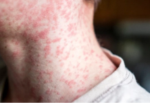 Во Република Српска потврден случај на тифус кај студентка од Индија