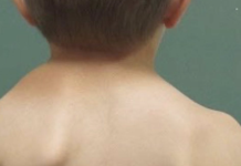 За прв пат во Македонија изведена операција од таков тип, кај 4-годишно дете: Браво за лекарите и храброто дете